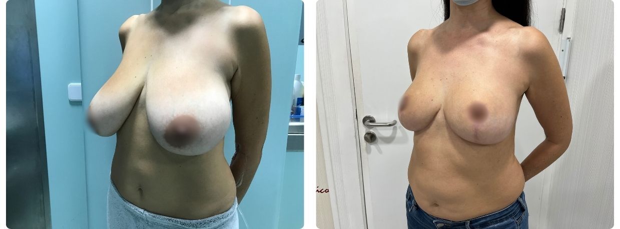 mamoplastia de reducción
