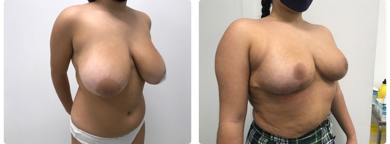 mamoplastia de reducción