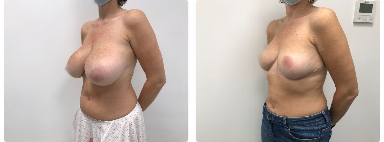 mamoplastia de reducción