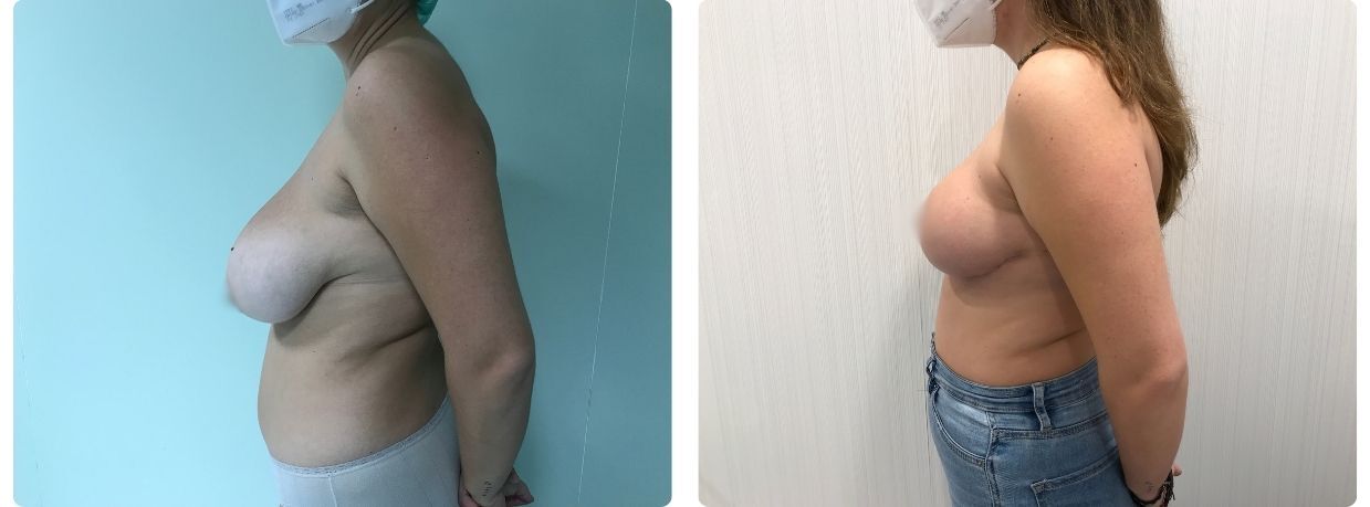 mamoplastia de reducción