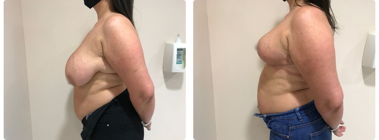 mamoplastia de reducción