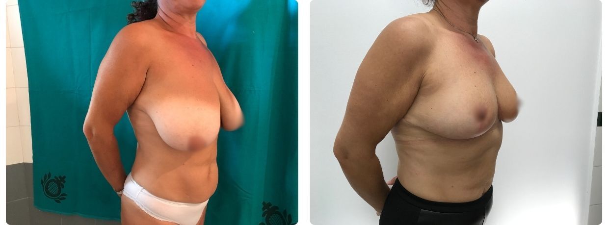 mamoplastia de reducción