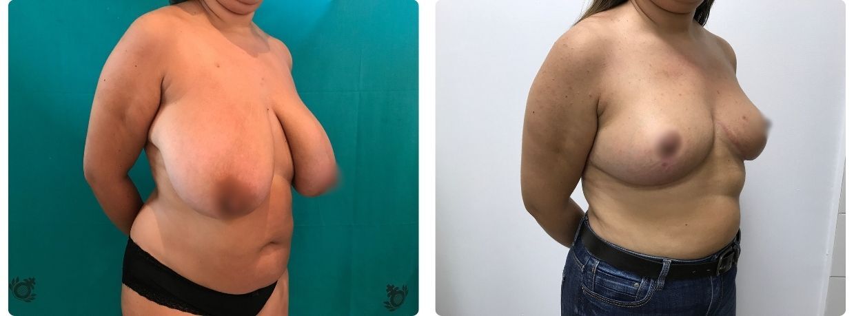 mamoplastia de reducción