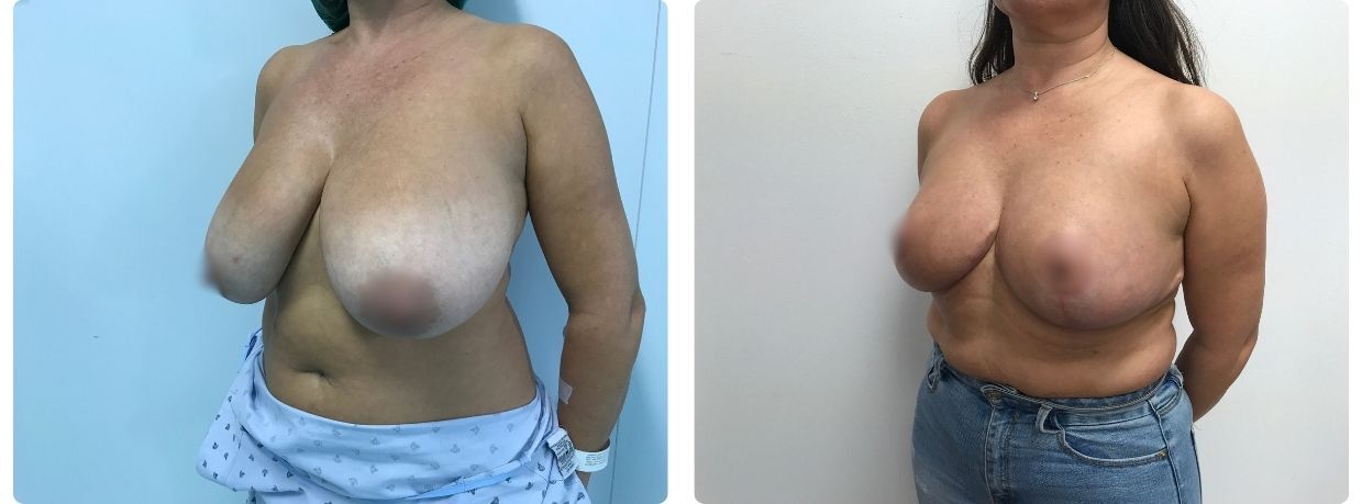 mamoplastia de reducción