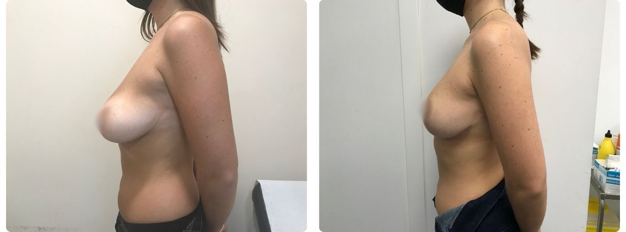 mastopexia implantes