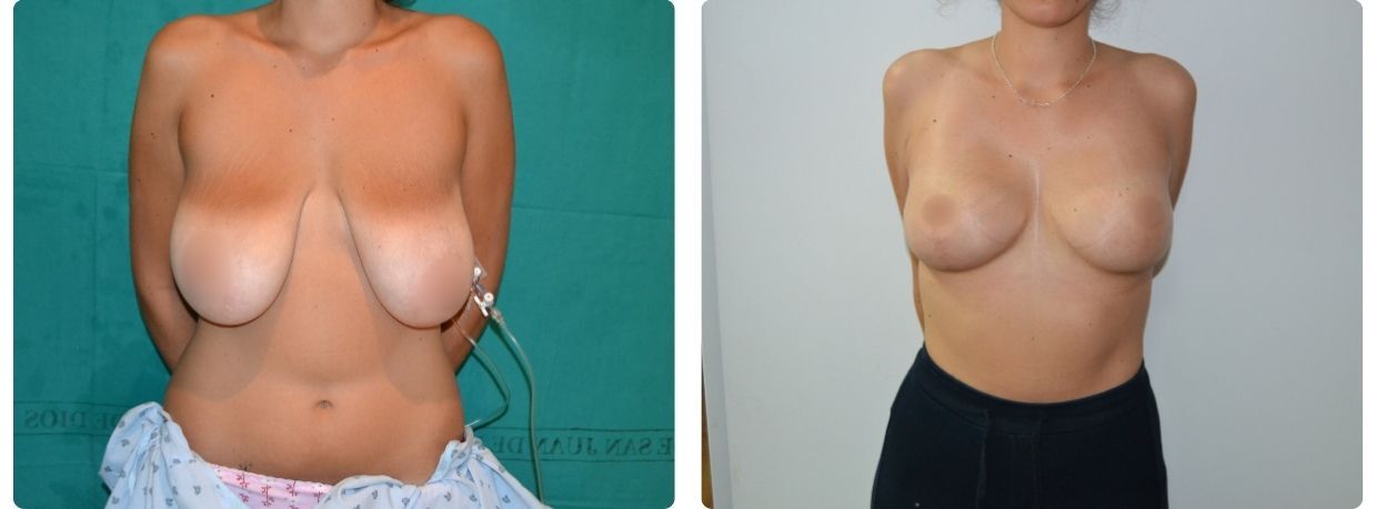 mastopexia sin implantes