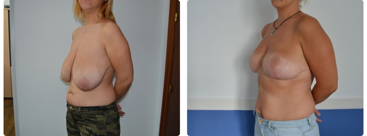 mastopexia sin implantes